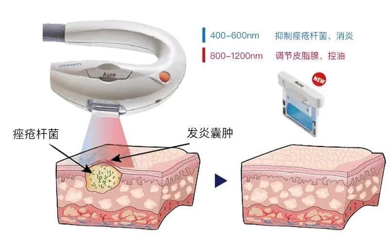 超光子中的痤疮滤光片作用皮肤